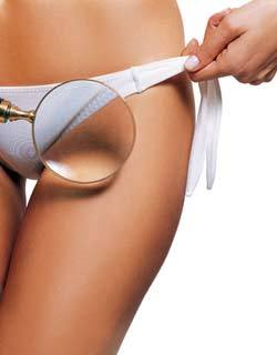 ブラジリアンワックス脱毛 女